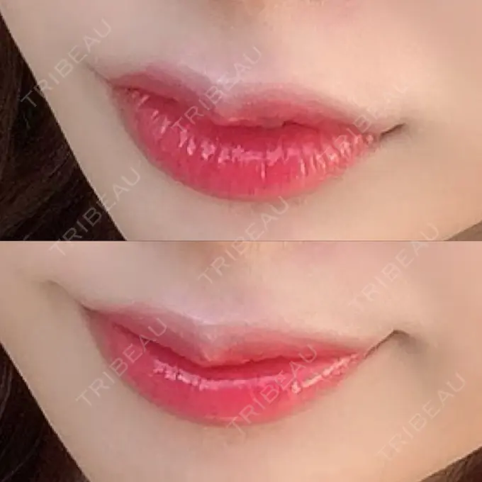 ヒアルロン酸注入（涙袋） / ヒアルロン酸注入（鼻） / ヒアルロン酸注入（唇） / ボトックス（口角） ルラ美容クリニック 大宮院 / ルラスキンクリニック 大宮院 DAY 10 メイン用