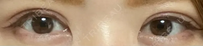 二重切開 / 上まぶたの脂肪取り 城本クリニック 豊橋院 AFTER メイン用