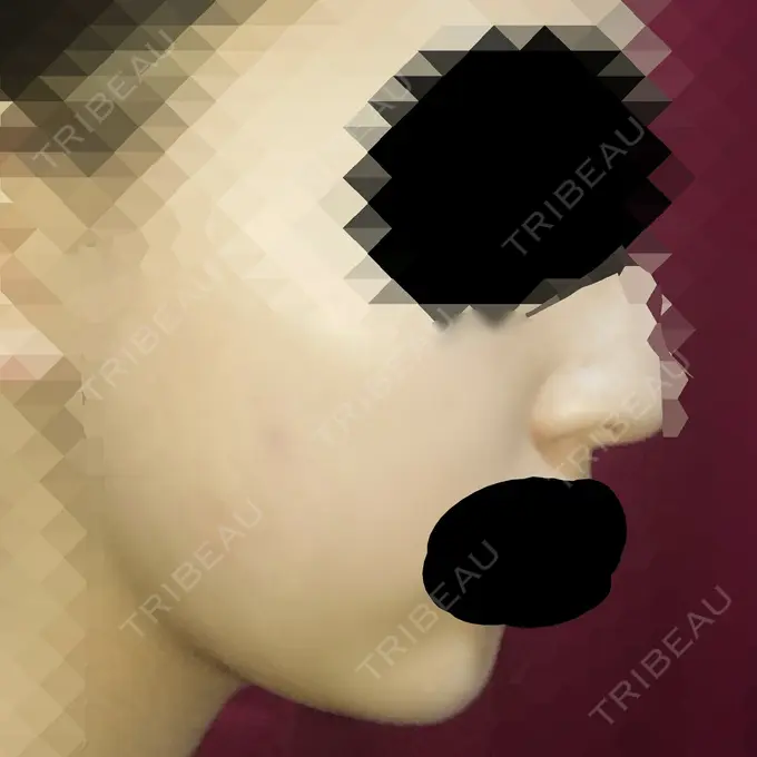 脂肪溶解注射（顔） ハートライフクリニック DAY 32 メイン用