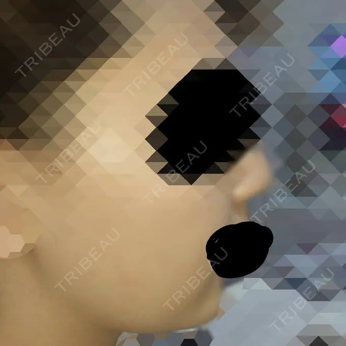 脂肪溶解注射（顔） ハートライフクリニック AFTER メイン用