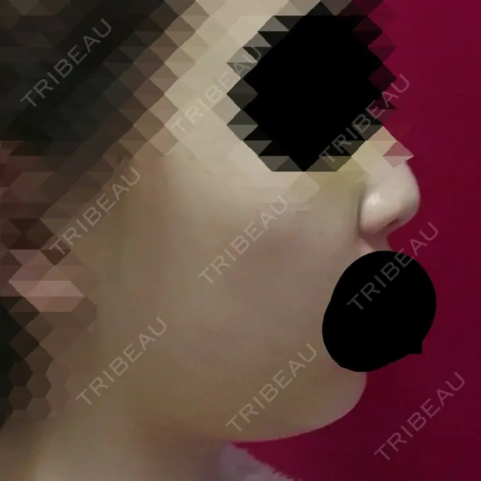 脂肪溶解注射（顔） ハートライフクリニック DAY 1 メイン用