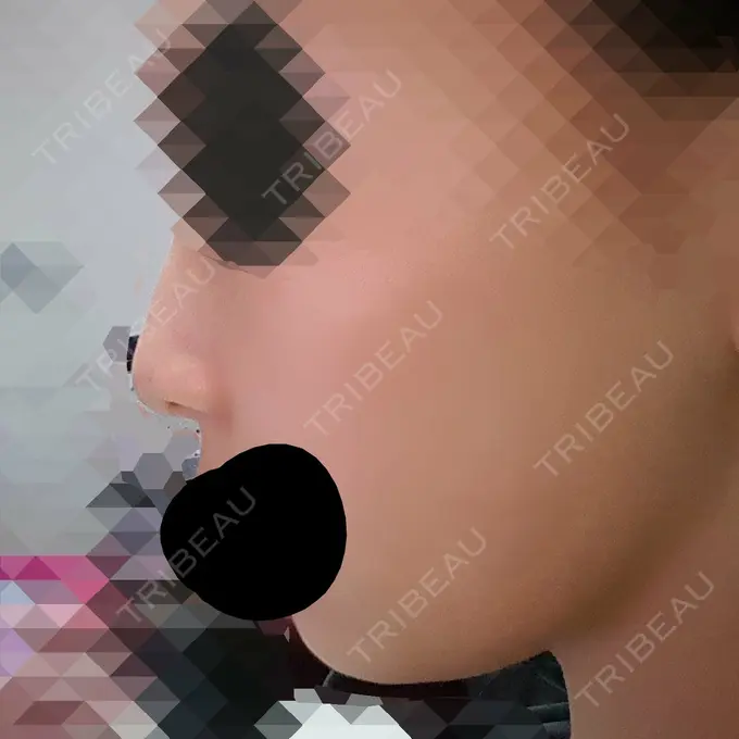 脂肪溶解注射（顔） ハートライフクリニック DAY 16 メイン用