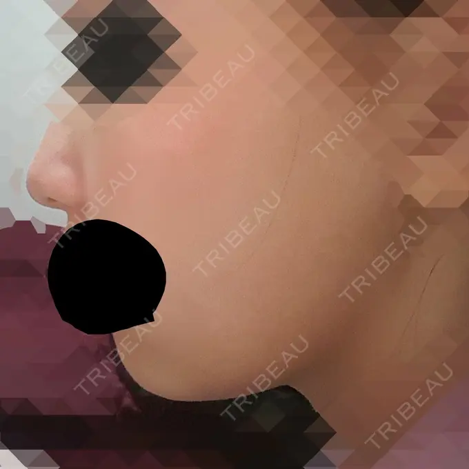 脂肪溶解注射（顔） ハートライフクリニック DAY 14 メイン用