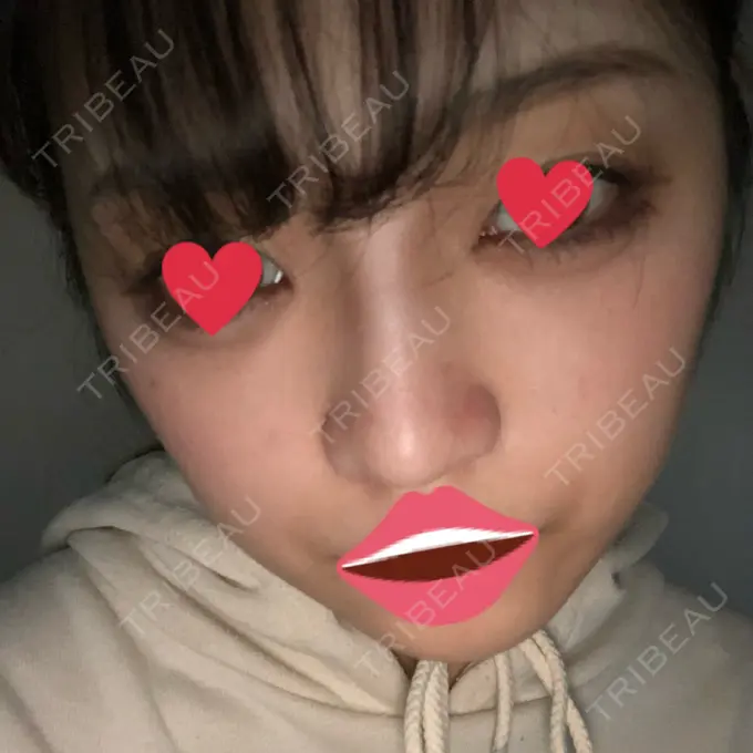 ヒアルロン酸注入（鼻） プライベートスキンクリニック 梅田本院 DAY 0 メイン用