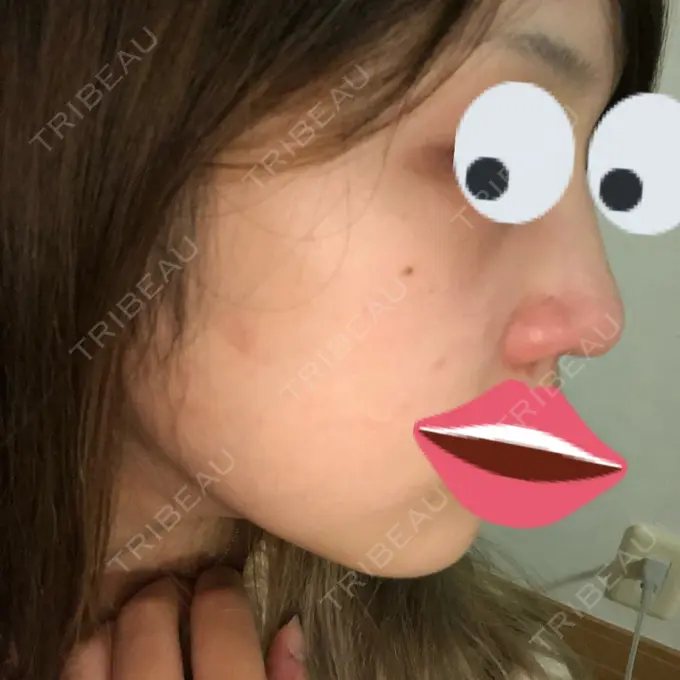 ヒアルロン酸注入（鼻） プライベートスキンクリニック 梅田本院 DAY 0 メイン用