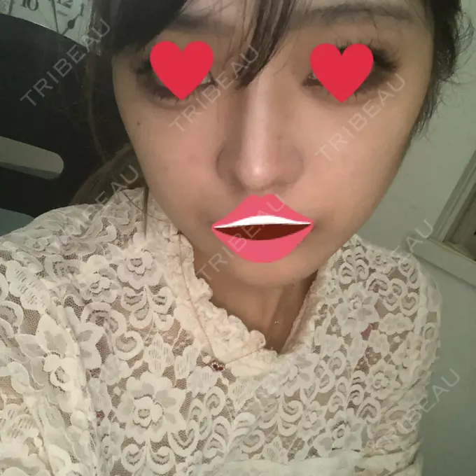 ヒアルロン酸注入（鼻） プライベートスキンクリニック 梅田本院 DAY 1 メイン用