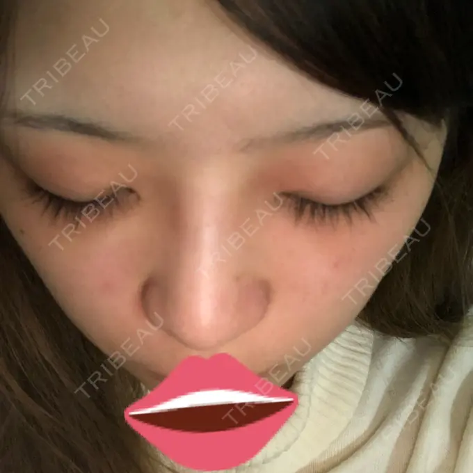 ヒアルロン酸注入（鼻） プライベートスキンクリニック 梅田本院 DAY 3 メイン用