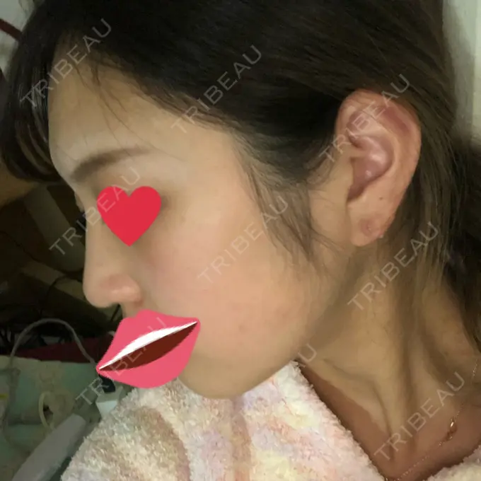 ヒアルロン酸注入（鼻） プライベートスキンクリニック 梅田本院 DAY 3 メイン用