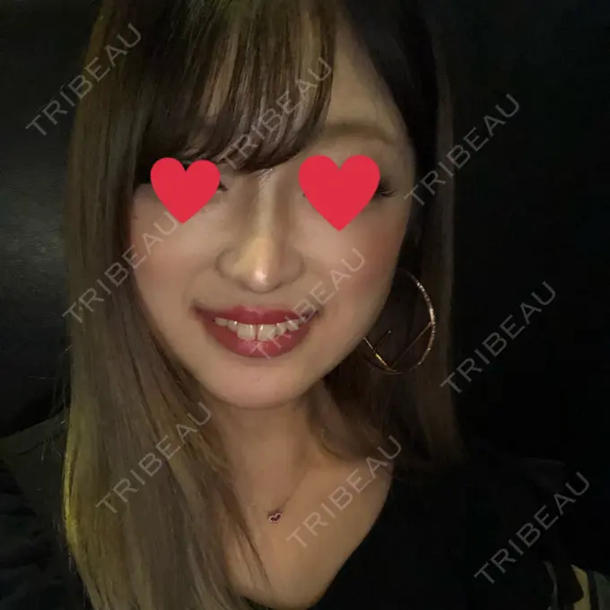 ヒアルロン酸注入（鼻） プライベートスキンクリニック 梅田本院 AFTER メイン用