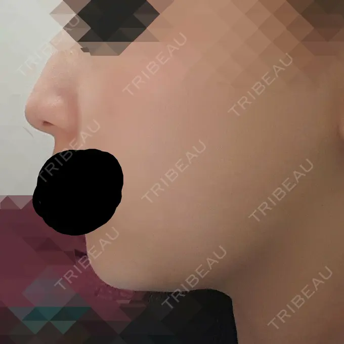 脂肪溶解注射（顔） ハートライフクリニック DAY 9 メイン用