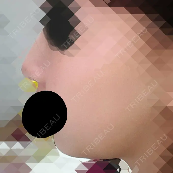 脂肪溶解注射（顔） ハートライフクリニック DAY 4 メイン用