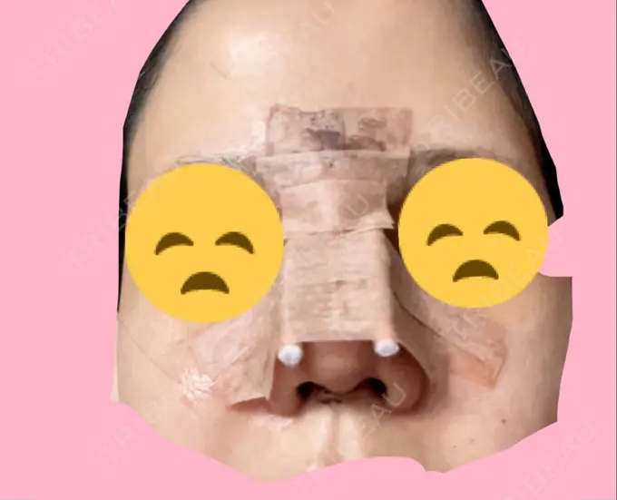 鼻尖形成（切開） / 軟骨移植 / その他（鼻） ジョウクリニック 那覇院 DAY 4 メイン用