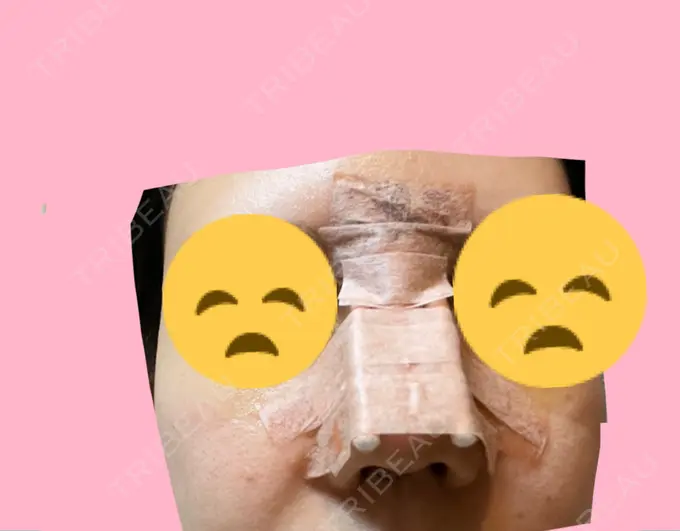 鼻尖形成（切開） / 軟骨移植 / その他（鼻） ジョウクリニック 那覇院 DAY 5 メイン用