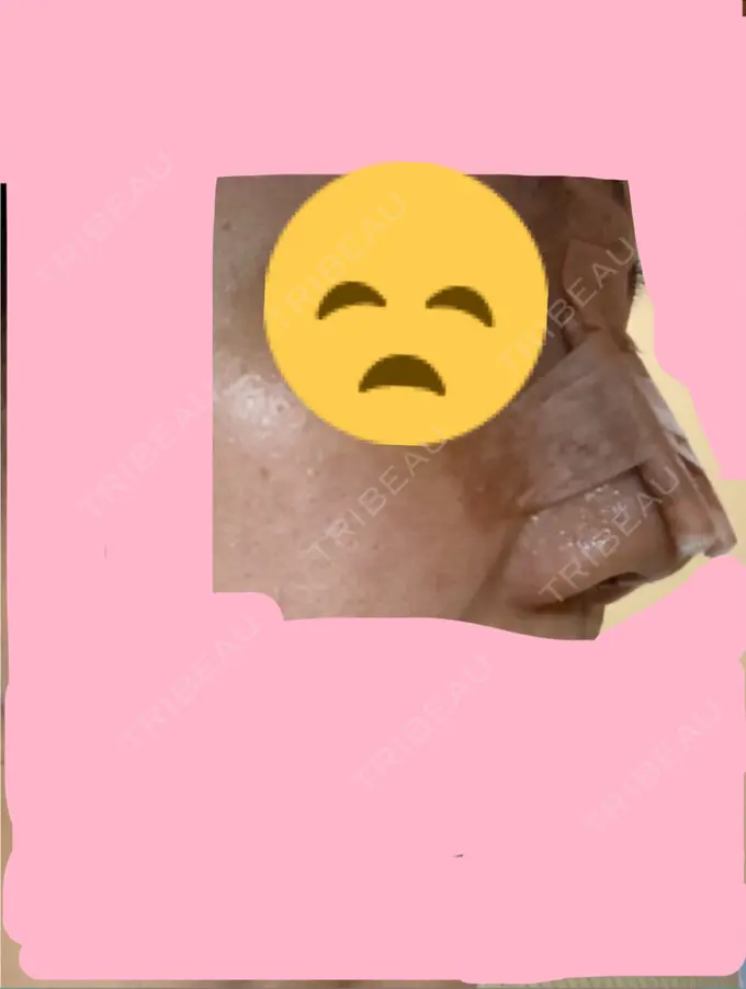 鼻尖形成（切開） / 軟骨移植 / その他（鼻） ジョウクリニック 那覇院 DAY 6 メイン用