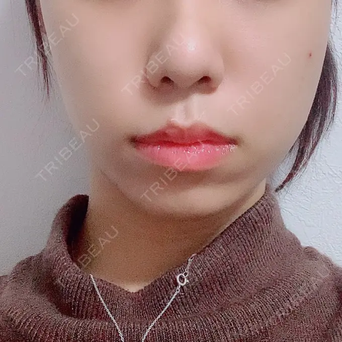 肌ヒアルロン酸注入（たるみ・シワ改善） / ボトックス（エラ・小顔） / その他（鼻） YBC横浜美容外科 大宮院 DAY 9 メイン用