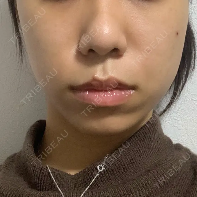 肌ヒアルロン酸注入（たるみ・シワ改善） / ボトックス（エラ・小顔） / その他（鼻） YBC横浜美容外科 大宮院 DAY 9 メイン用