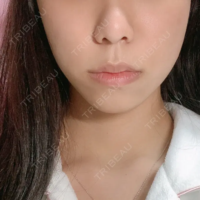 肌ヒアルロン酸注入（たるみ・シワ改善） / ボトックス（エラ・小顔） / その他（鼻） YBC横浜美容外科 大宮院 DAY 10 メイン用