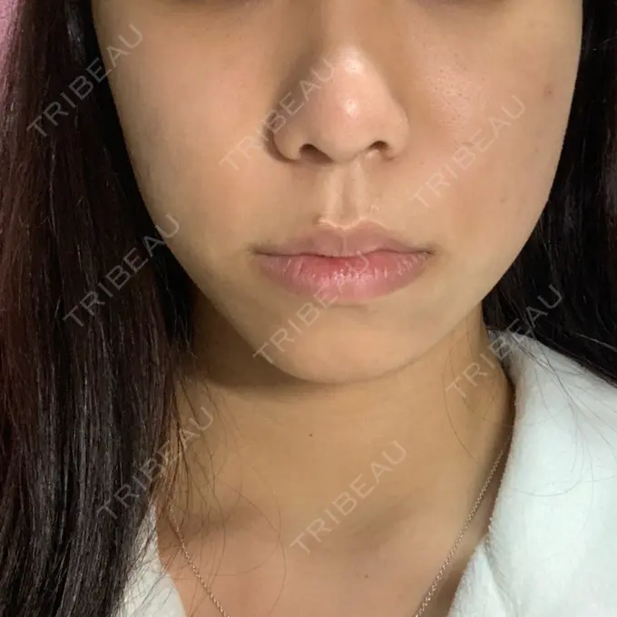 肌ヒアルロン酸注入（たるみ・シワ改善） / ボトックス（エラ・小顔） / その他（鼻） YBC横浜美容外科 大宮院 DAY 10 メイン用