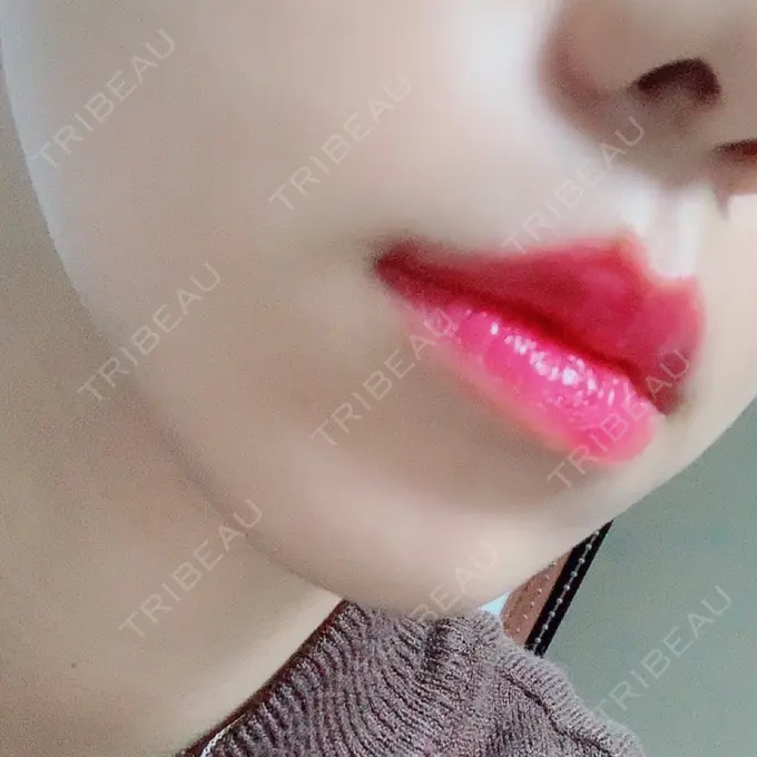 肌ヒアルロン酸注入（たるみ・シワ改善） / ボトックス（エラ・小顔） / その他（鼻） YBC横浜美容外科 大宮院 DAY 9 メイン用