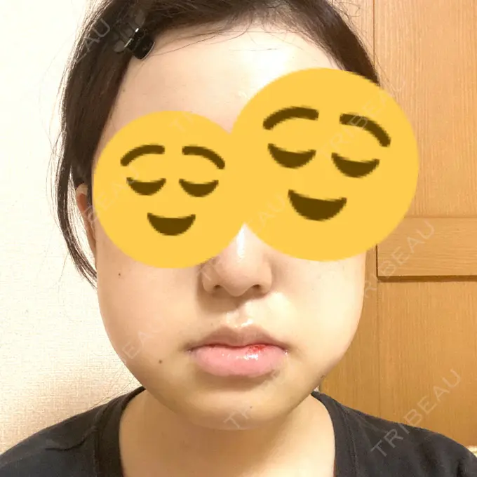 骨切り（あご） / 骨削り（エラ） リラ・クラニオフェイシャル・クリニック 大阪院 DAY 6 メイン用