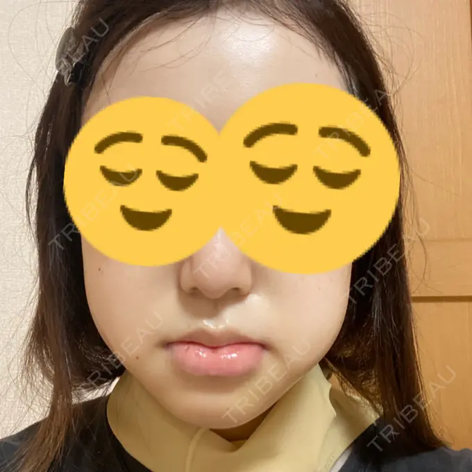 骨切り（あご） / 骨削り（エラ） リラ・クラニオフェイシャル・クリニック 大阪院 DAY 7 メイン用