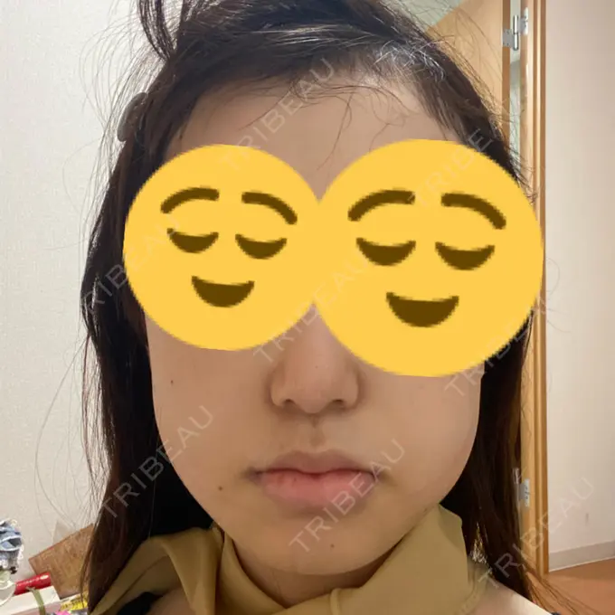 骨切り（あご） / 骨削り（エラ） リラ・クラニオフェイシャル・クリニック 大阪院 DAY 9 メイン用