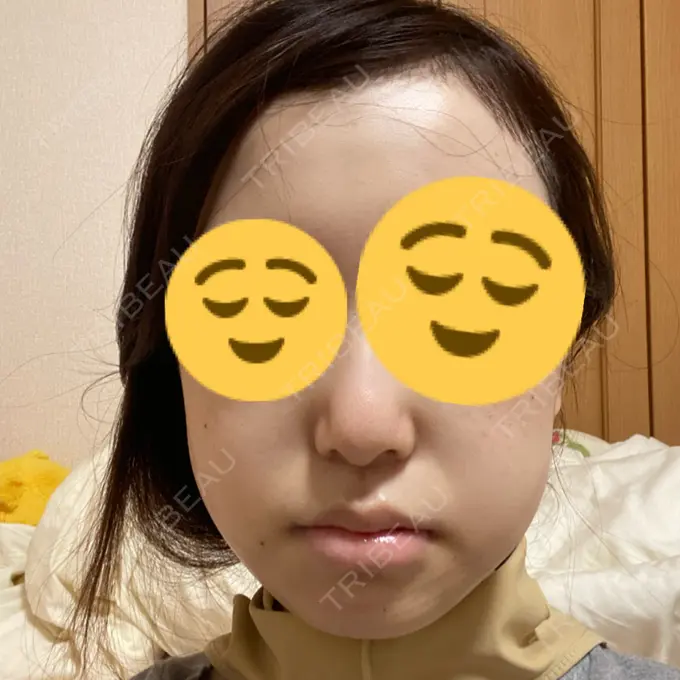 骨切り（あご） / 骨削り（エラ） リラ・クラニオフェイシャル・クリニック 大阪院 DAY 10 メイン用