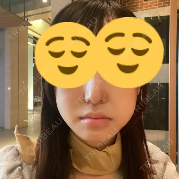 骨切り（あご） / 骨削り（エラ） リラ・クラニオフェイシャル・クリニック 大阪院 DAY 13 メイン用