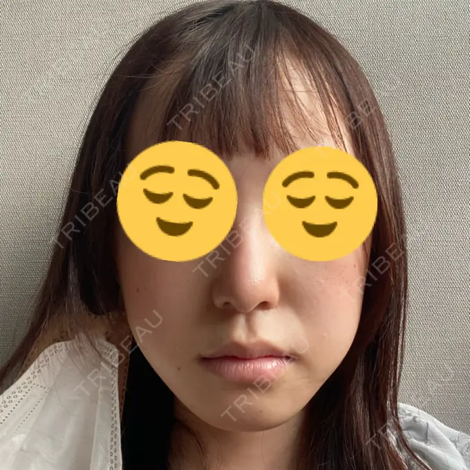 骨切り（あご） / 骨削り（エラ） リラ・クラニオフェイシャル・クリニック 大阪院 DAY 20 メイン用