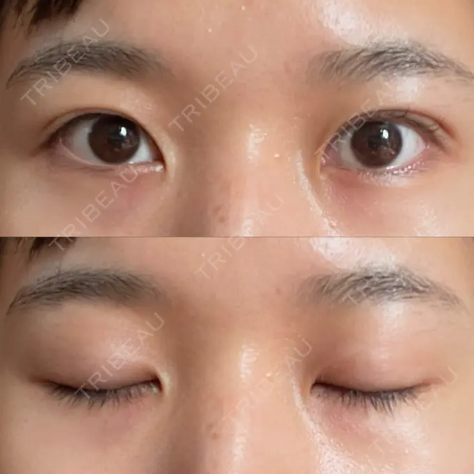 二重埋没 湘南美容クリニック 赤坂見附院 DAY 456 メイン用