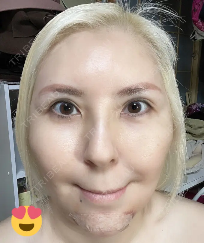 あごプロテーゼ / 輪郭修正 / ボトックス（あご） / ヒアルロン酸注入（頬） CLASSY 仙台美容外科・美容皮膚科 DAY 2 メイン用