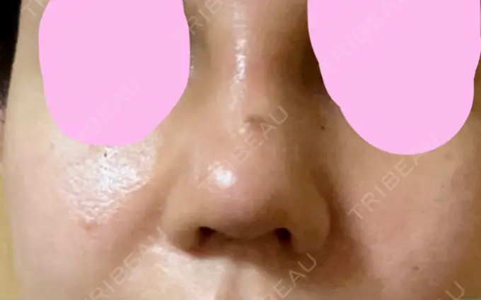 鼻尖形成（切開） / 軟骨移植 / その他（鼻） ジョウクリニック 那覇院 DAY 7 メイン用