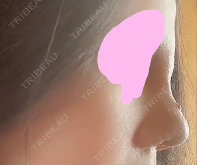 鼻尖形成（切開） / 軟骨移植 / その他（鼻） ジョウクリニック 那覇院 DAY 8 メイン用