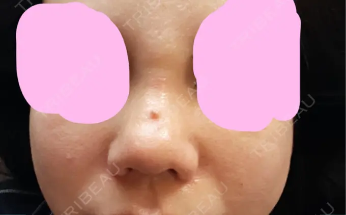 鼻尖形成（切開） / 軟骨移植 / その他（鼻） ジョウクリニック 那覇院 DAY 9 メイン用