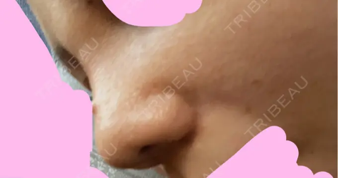 鼻尖形成（切開） / 軟骨移植 / その他（鼻） ジョウクリニック 那覇院 DAY 11 メイン用