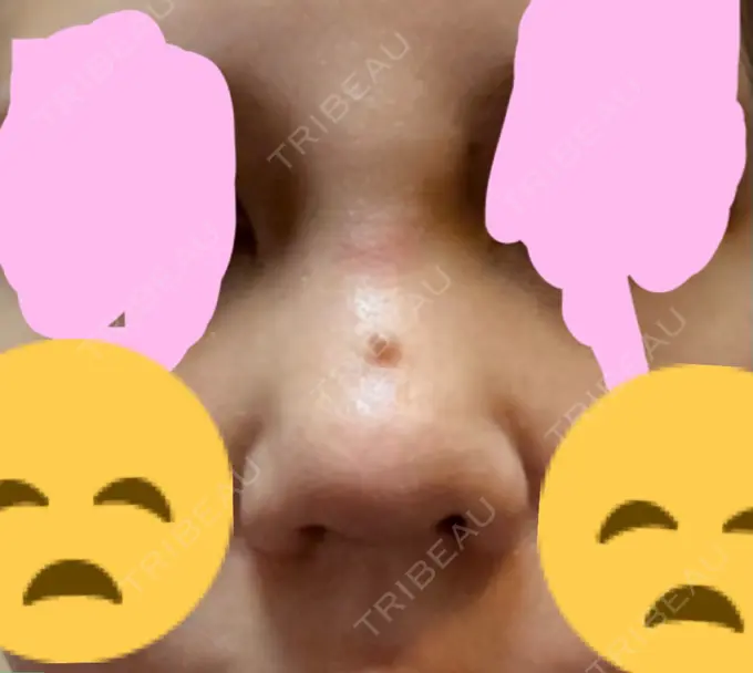 鼻尖形成（切開） / 軟骨移植 / その他（鼻） ジョウクリニック 那覇院 AFTER メイン用