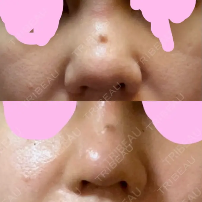 鼻尖形成（切開） / 軟骨移植 / その他（鼻） ジョウクリニック 那覇院 DAY 12 メイン用