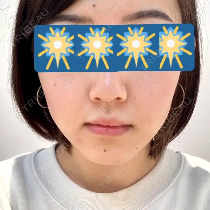 ハイフ（顔） STARS CLINIC DAY 0 メイン用