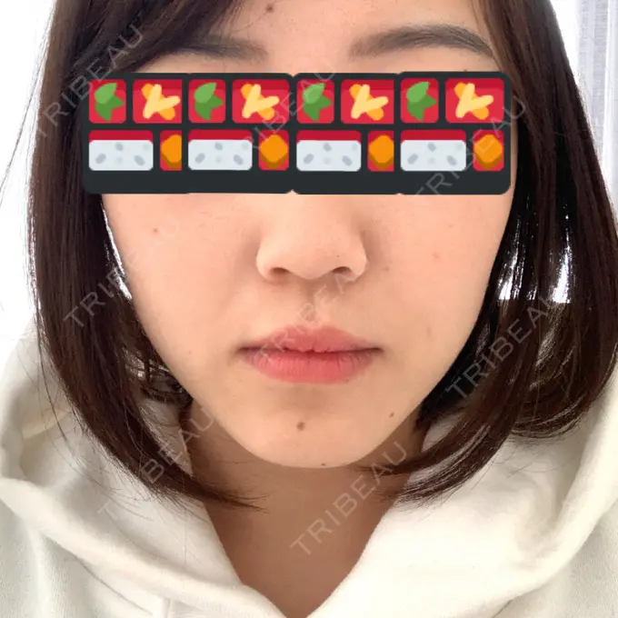 ハイフ（顔） STARS CLINIC DAY 11 メイン用