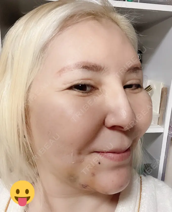 あごプロテーゼ / 輪郭修正 / ボトックス（あご） / ヒアルロン酸注入（頬） CLASSY 仙台美容外科・美容皮膚科 DAY 3 メイン用