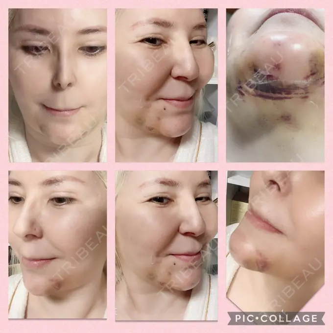 あごプロテーゼ / 輪郭修正 / ボトックス（あご） / ヒアルロン酸注入（頬） CLASSY 仙台美容外科・美容皮膚科 DAY 3 メイン用