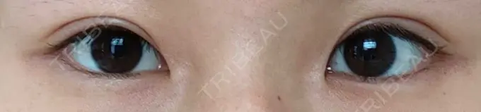 二重切開 / 眼瞼下垂（切開） 城本クリニック 福岡院 AFTER メイン用