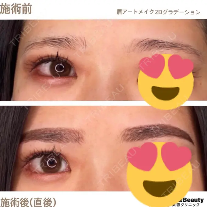 アートメイク（眉） 筋肉・美容クリニック AFTER メイン用