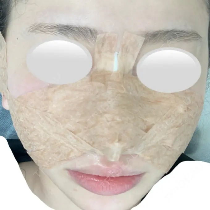 鼻中隔延長（切開） / 小鼻縮小（切開） / 鼻尖縮小 みずほクリニック DAY 0 メイン用