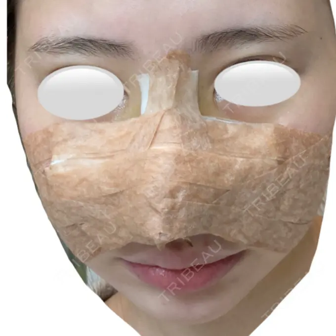 鼻中隔延長（切開） / 小鼻縮小（切開） / 鼻尖縮小 みずほクリニック DAY 3 メイン用