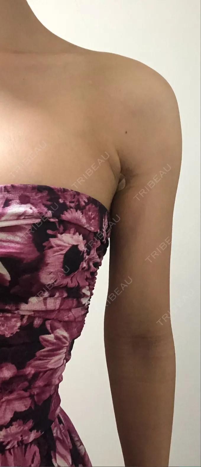 脂肪吸引（二の腕） ヨンセスリムライン DAY 22 メイン用