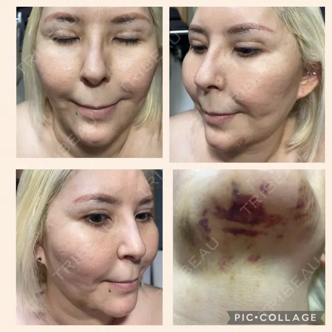 あごプロテーゼ / 輪郭修正 / ボトックス（あご） / ヒアルロン酸注入（頬） CLASSY 仙台美容外科・美容皮膚科 DAY 7 メイン用