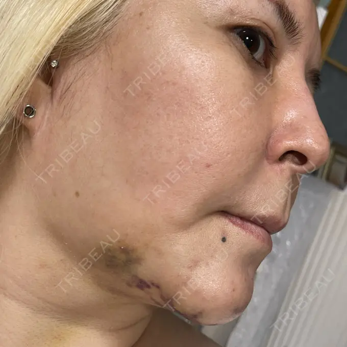 あごプロテーゼ / 輪郭修正 / ボトックス（あご） / ヒアルロン酸注入（頬） CLASSY 仙台美容外科・美容皮膚科 DAY 7 メイン用