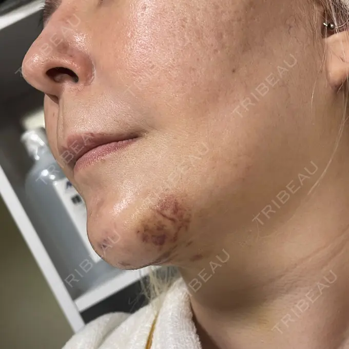 あごプロテーゼ / 輪郭修正 / ボトックス（あご） / ヒアルロン酸注入（頬） CLASSY 仙台美容外科・美容皮膚科 DAY 7 メイン用