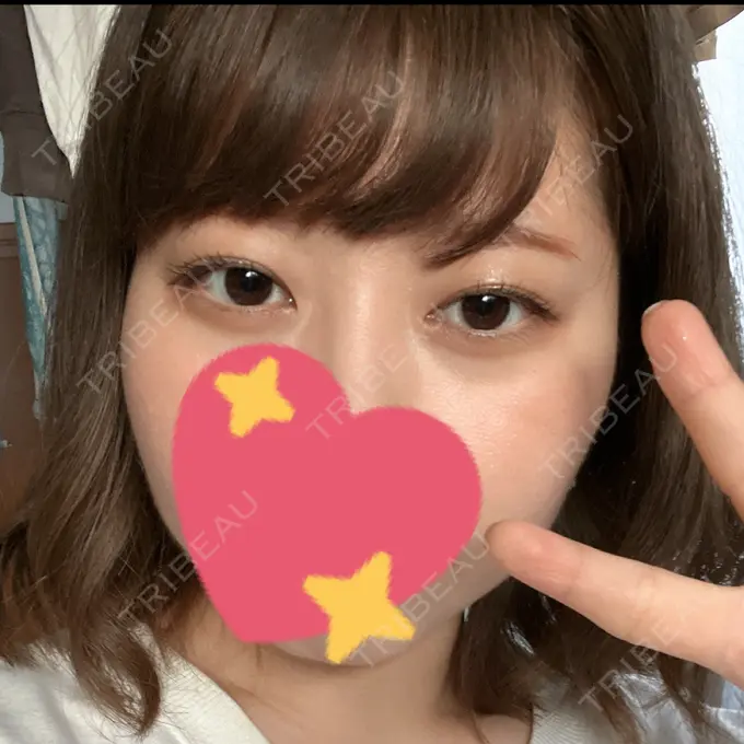 二重埋没 船橋中央クリニック AFTER メイン用